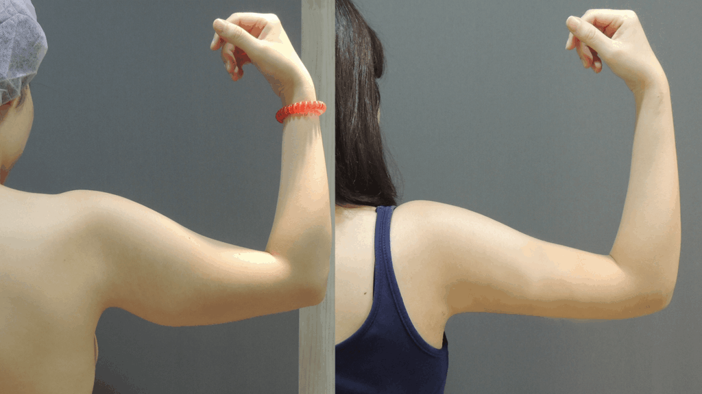 Case3 威塑抽脂+超能電漿 (複合式電漿抽脂) - 手臂