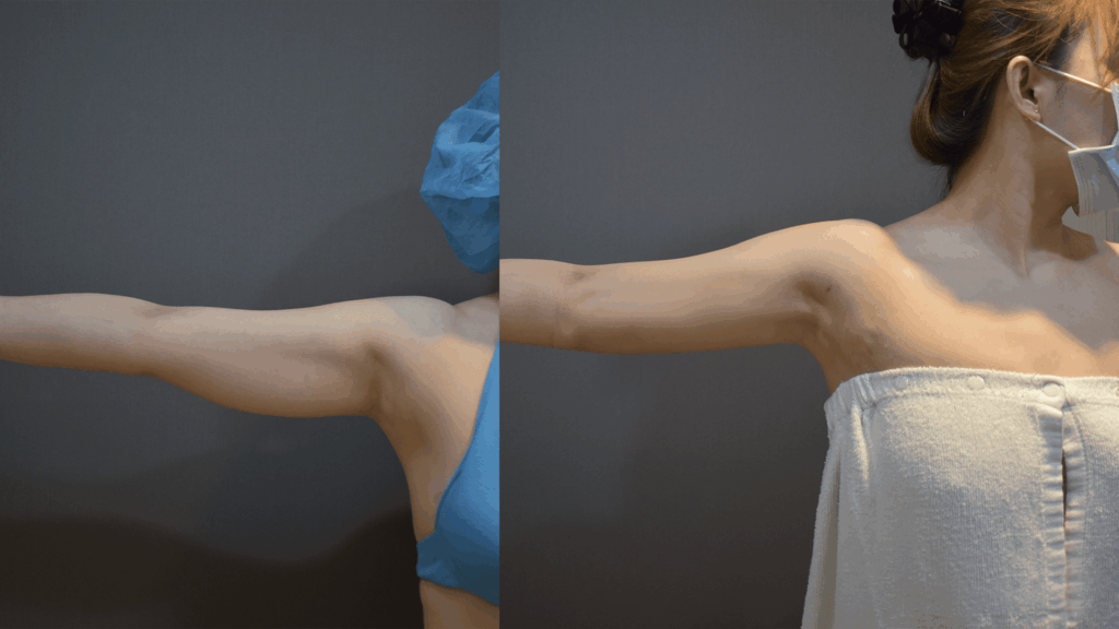 Case4 超能電漿+威塑抽脂 (複合式電漿抽脂) - 手臂