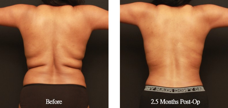 Case5 威塑抽脂+超能電漿 (複合式電漿抽脂) - 後背 + 後側腰 + 後腰