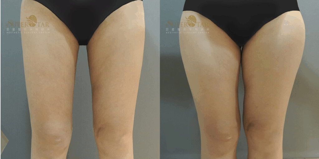 Case6 電漿抽脂 - 大腿