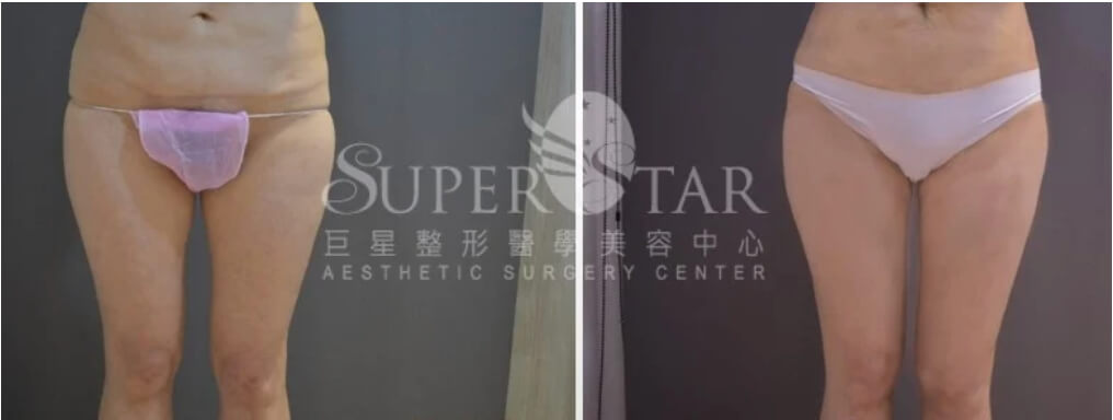 Case8 複合式電漿抽脂 - 大腿