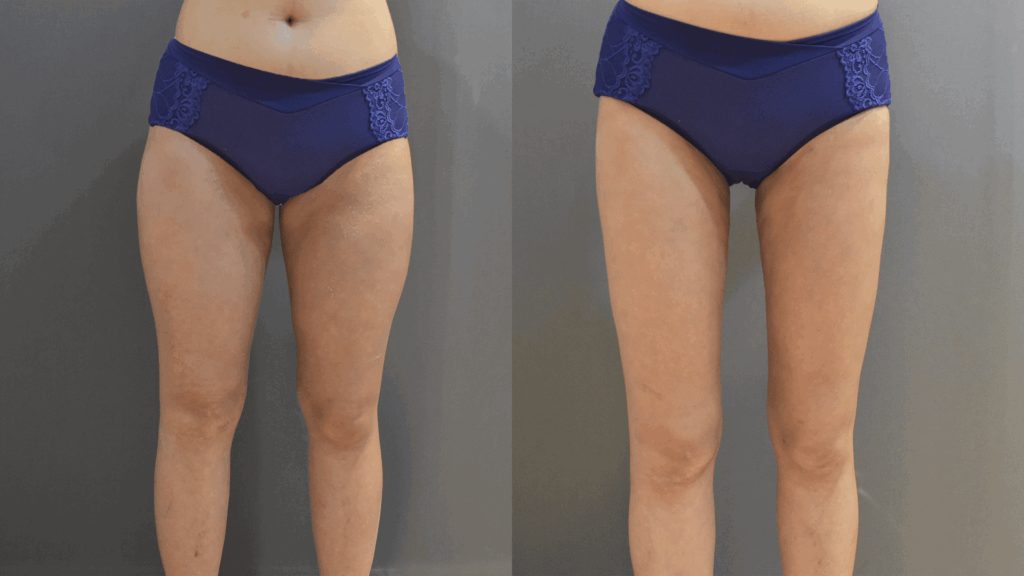 Case9 複合式電漿抽脂 - 大腿