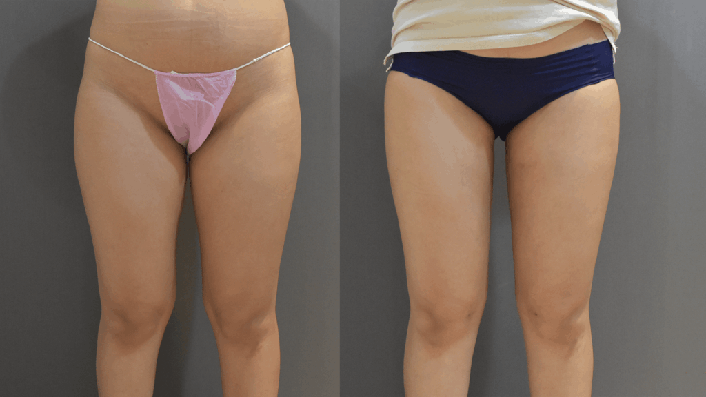 Case10 複合式電漿抽脂 - 威塑抽脂+超能電漿 - 大腿抽脂