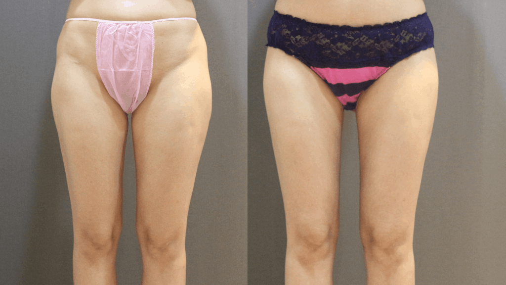 Case11 複合式電漿抽脂 - 威塑抽脂+超能電漿 - 大腿抽脂