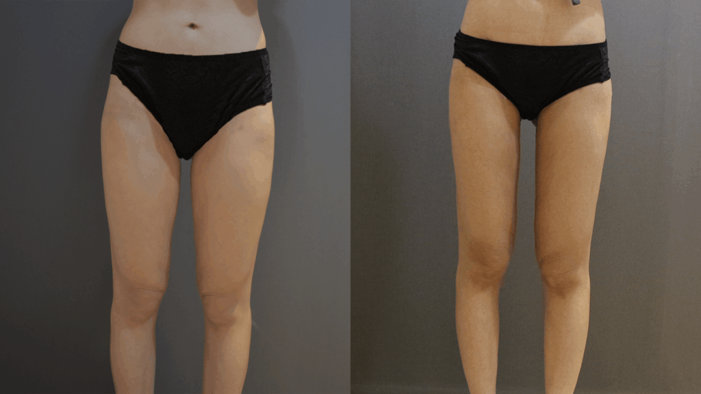 Case12 複合式電漿抽脂 - 威塑抽脂+超能電漿 - 大腿抽脂