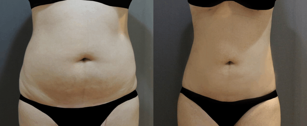 Case14 複合式電漿抽脂 - 威塑抽脂+超能電漿 - 腹部抽脂