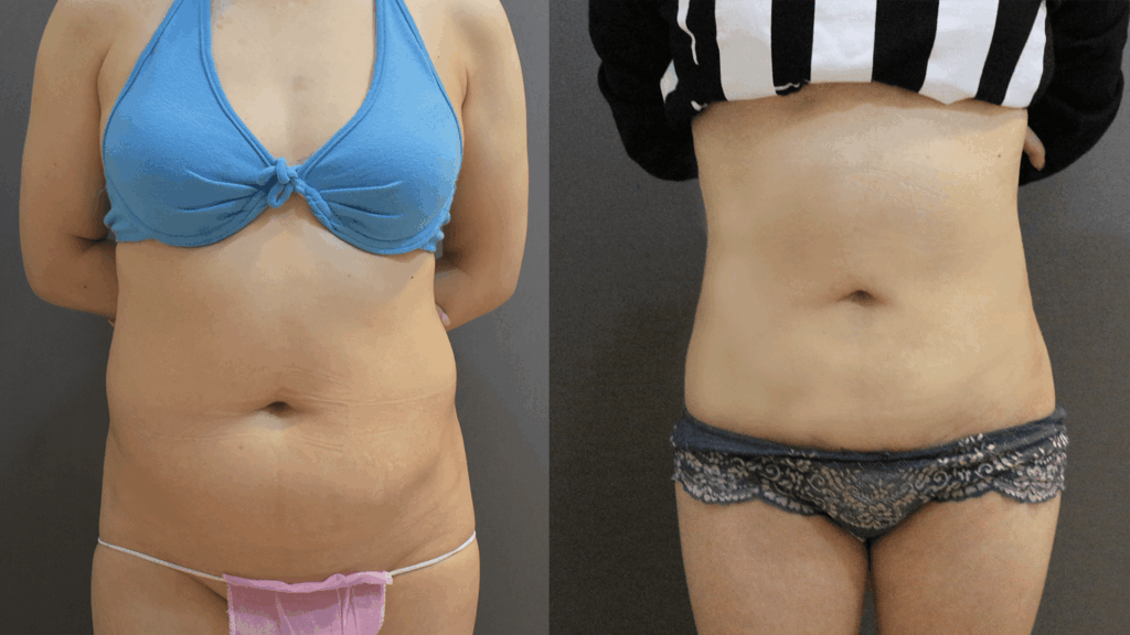 Case16 複合式電漿抽脂 - 威塑抽脂+超能電漿 - 腹部抽脂