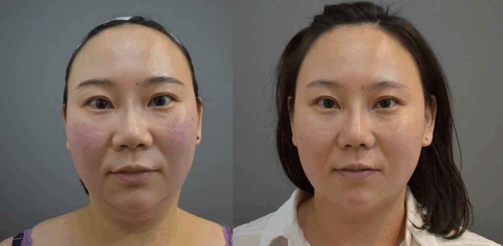 Case21 超能電漿抽脂 - 天鵝頸手術 - 雙下巴抽脂, 下臉輪廓線抽脂1