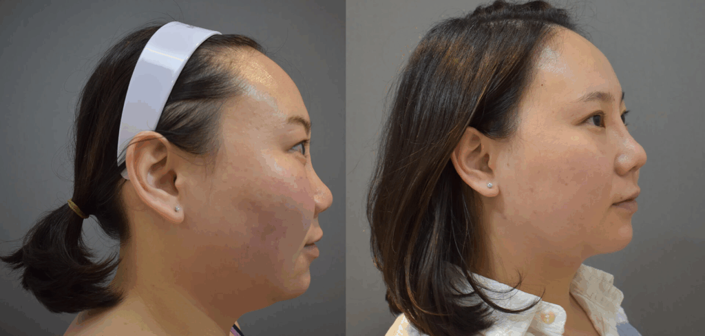 Case21 超能電漿抽脂 - 天鵝頸手術 - 雙下巴抽脂, 下臉輪廓線抽脂2