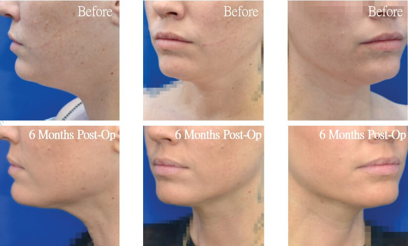 Case22 超能電漿抽脂 - 天鵝頸手術 - 雙下巴抽脂, 下臉輪廓線抽脂