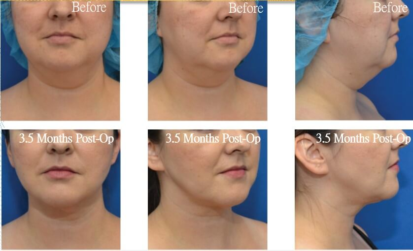 Case23 超能電漿抽脂 - 天鵝頸手術 - 雙下巴抽脂, 下臉輪廓線抽脂