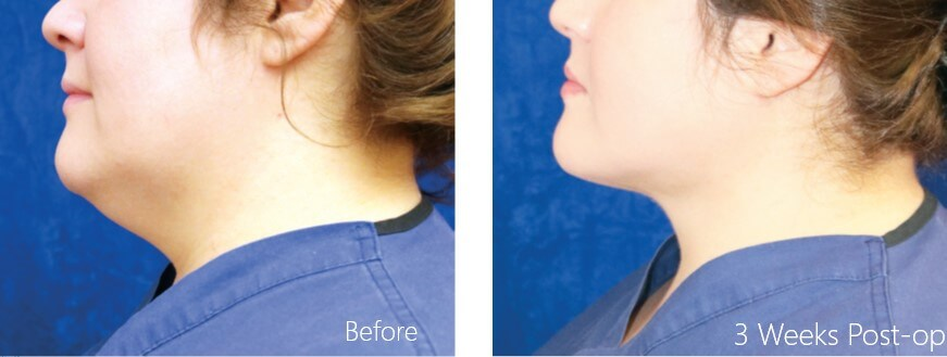 Case24 超能電漿抽脂 - 天鵝頸手術 - 雙下巴抽脂, 下臉輪廓線抽脂