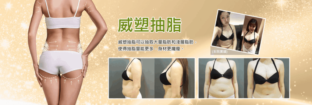 - 抽脂手術特搜評比：推薦威塑二代，威塑抽脂線條明顯，自體脂肪隆乳存活率佳 -
