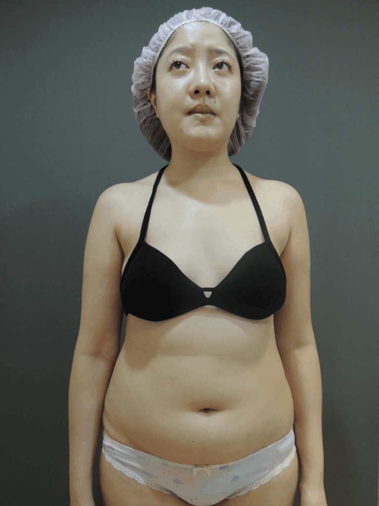 案例分享：二代威塑抽脂 + 果凍矽膠隆乳 (Mommy Makeover)2