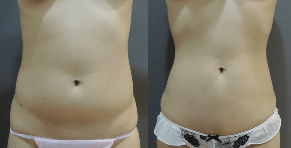 Case 1: 腹部/腰部 威塑抽脂正面