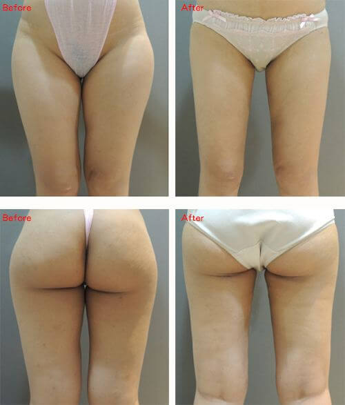 Case 3: 大腿 威塑抽脂