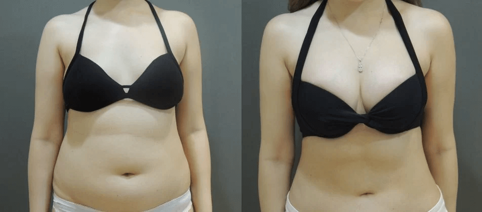 Case 4: 腹部抽脂 + 果凍矽膠隆乳正面