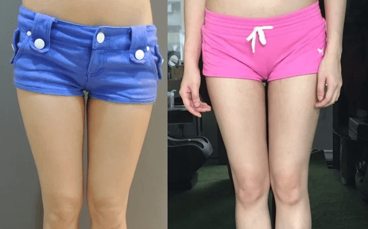 Case 5: 大腿威塑抽脂