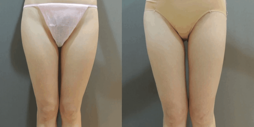 Case 6: 大腿環狀抽脂