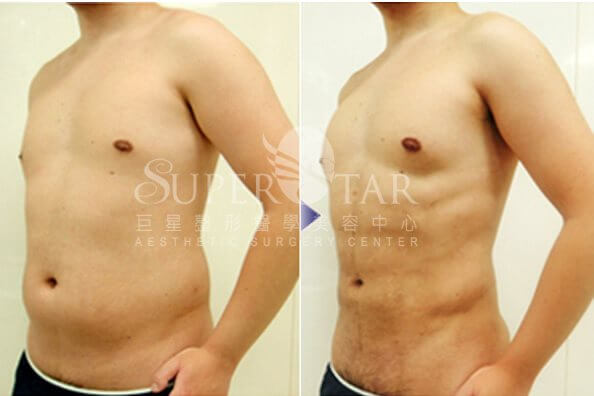 Case 8: 腹部抽脂 + 六塊肌雕塑