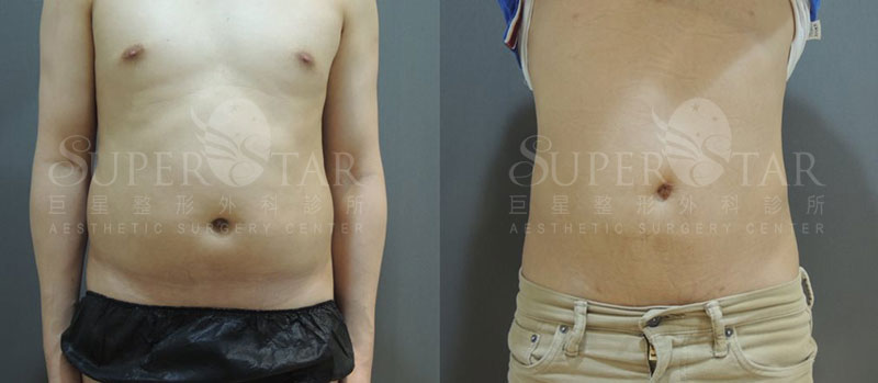 Case10 威塑抽脂 – 腹部抽脂