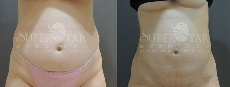 Case11 二代威塑抽脂 – 腹部抽脂