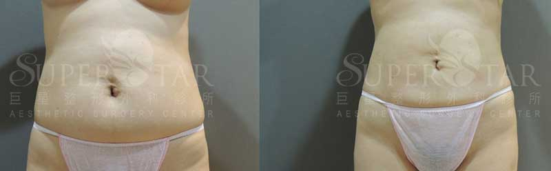 Case12 威塑抽脂 – 腹部抽脂, 肚子抽脂
