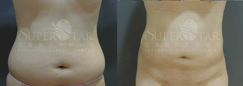 Case 13: 腹部抽脂 + 後腰肉 (Love Handles) 消除 1