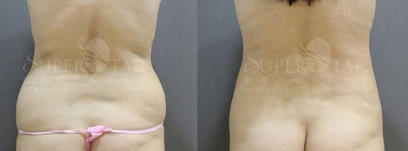 Case 13: 腹部抽脂 + 後腰肉 (Love Handles) 消除 2