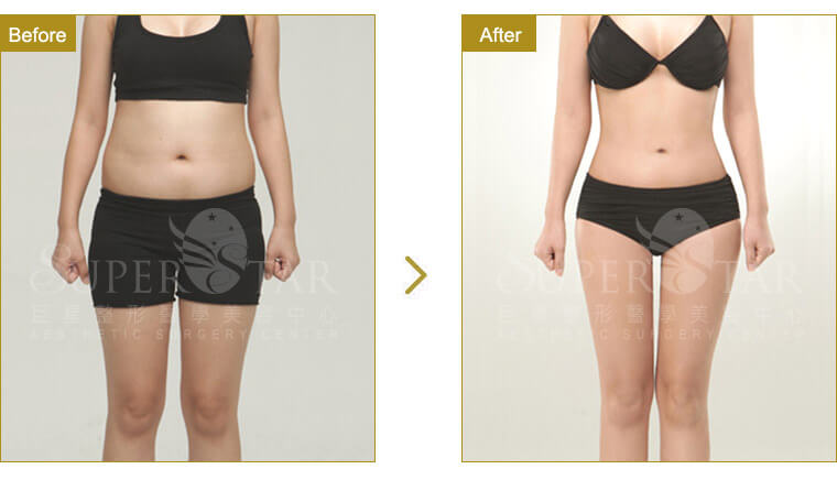 Case14 威塑抽脂 – 腿部抽脂, 腹部抽脂