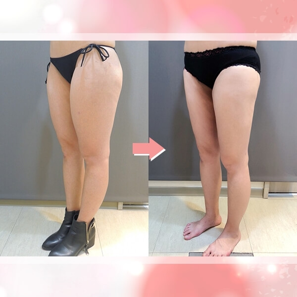 Case 15: 大腿抽脂 + 自體脂肪隆乳2