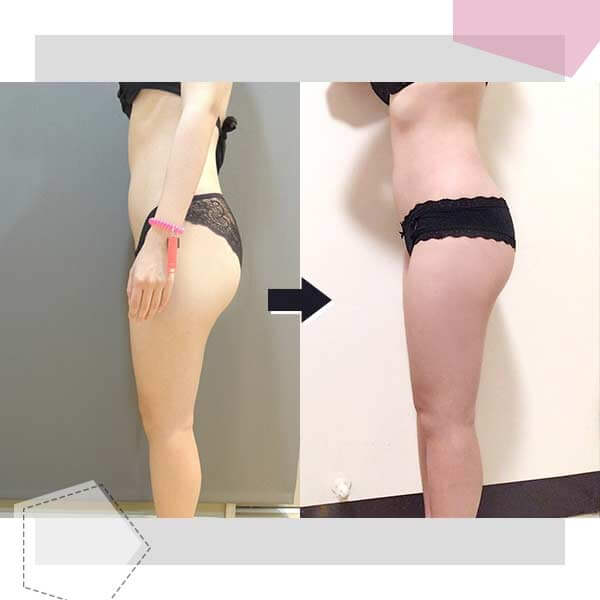 Case16 威塑抽脂 – 腿部抽脂1