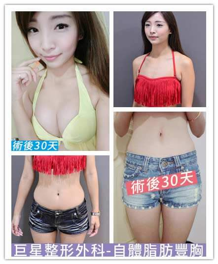 Case 1: 威塑 自體脂肪隆乳 (補胸)1