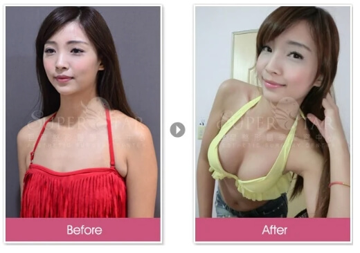 Case 1: 威塑 自體脂肪隆乳 (補胸)3