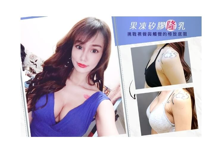 Case 1: MOTIVA 魔滴隆乳 | AA 罩杯 ⇒ D 罩杯