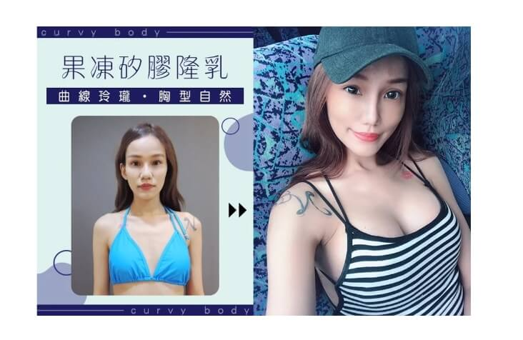 Case 1: MOTIVA 魔滴隆乳 | AA 罩杯 ⇒ D 罩杯2