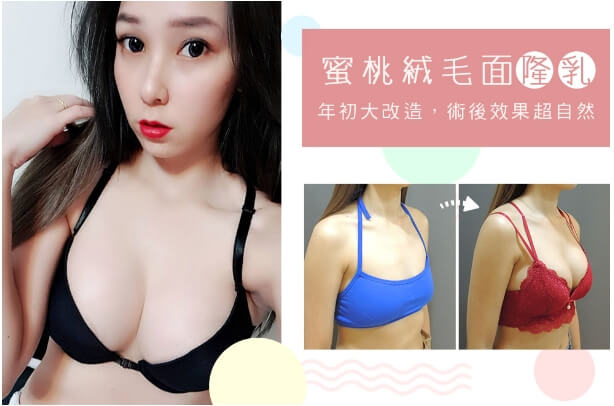 Case 1: 雙面蜜桃隆乳 | A 罩杯 ⇒ D 罩杯