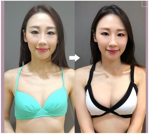 Case 3: 雙面蜜桃隆乳 | A 罩杯 ⇒ D 罩杯1