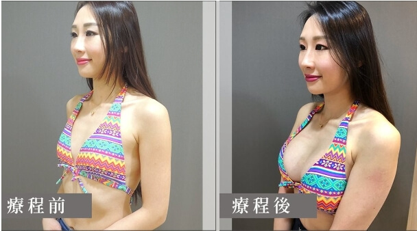 Case 3: 雙面蜜桃隆乳 | A 罩杯 ⇒ D 罩杯2