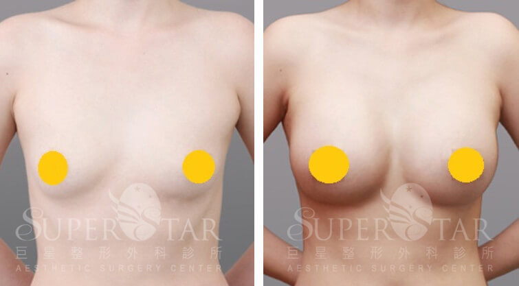 Case 5: 乳暈旁隆乳 | A 罩杯 ⇒ 大 C 罩杯1