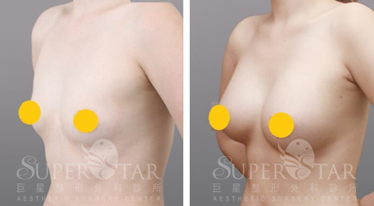 Case 5: 乳暈旁隆乳 | A 罩杯 ⇒ 大 C 罩杯2