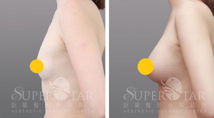 Case 5: 乳暈旁隆乳 | A 罩杯 ⇒ 大 C 罩杯3