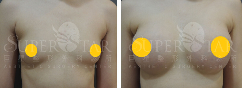 Case 6: 乳暈旁隆乳 | A 罩杯 ⇒ 大 C 罩杯1