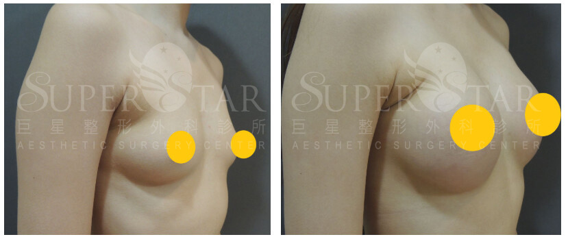 Case 6: 乳暈旁隆乳 | A 罩杯 ⇒ 大 C 罩杯2