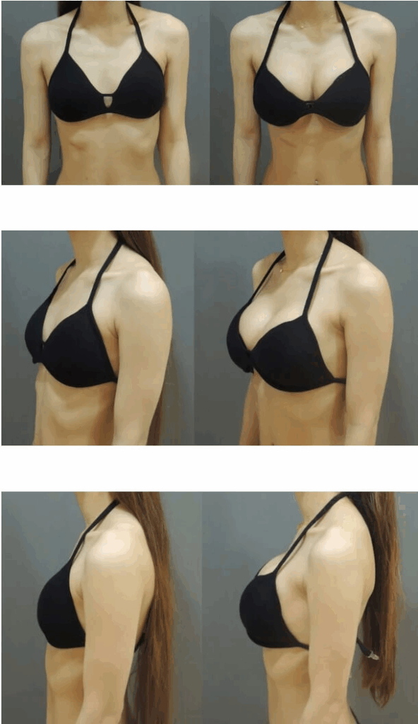 Case 7: 乳暈旁隆乳 | AA 罩杯 ⇒ 大 C 罩杯