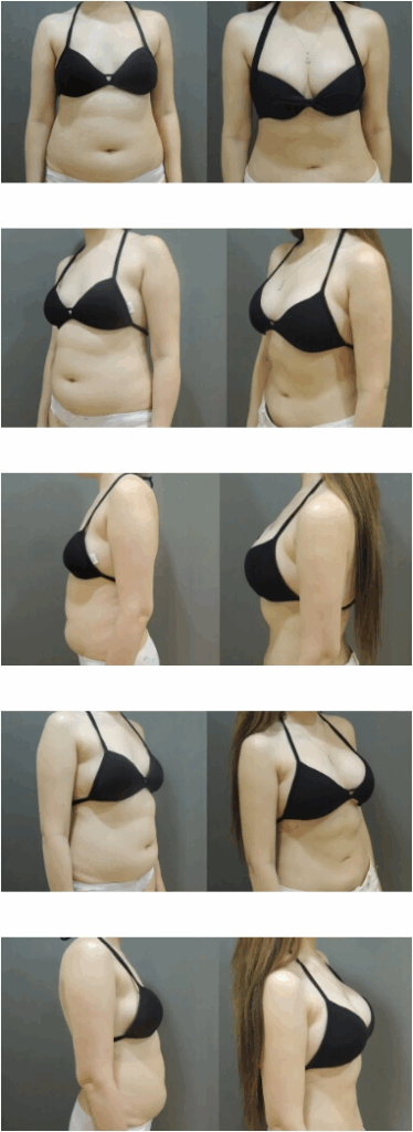 Case 8: 乳下緣隆乳 | A 罩杯 ⇒ D 罩杯1