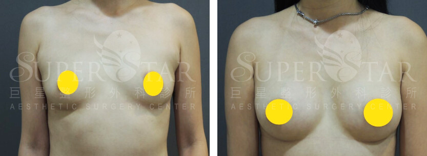 Case 9: 產後乳房萎縮改善 - 乳暈旁隆乳 | A 罩杯 ⇒ 大 C 罩杯1
