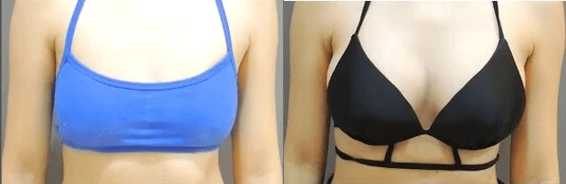 Case 1: 全程內視鏡腋下隆乳 | A 罩杯 ⇒ D 罩杯1