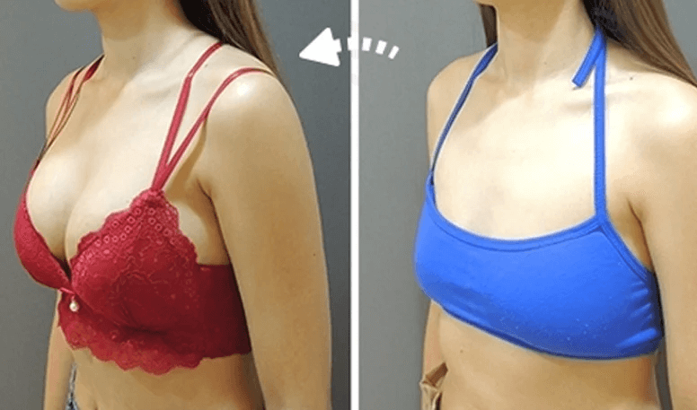 Case 1: 全程內視鏡腋下隆乳 | A 罩杯 ⇒ D 罩杯2