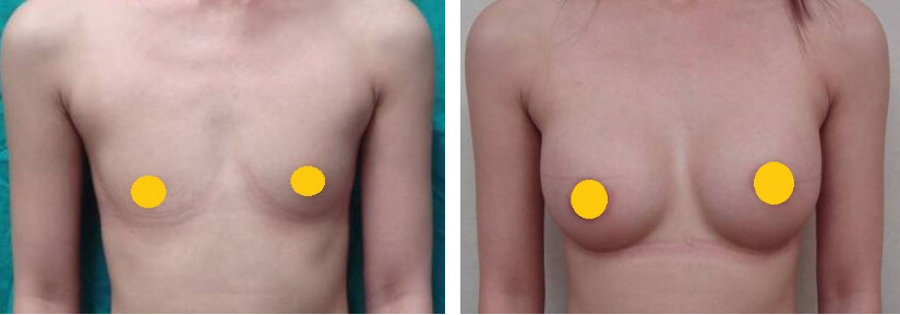 Case 2: 全程內視鏡腋下隆乳 | AA 罩杯 ⇒ C 罩杯